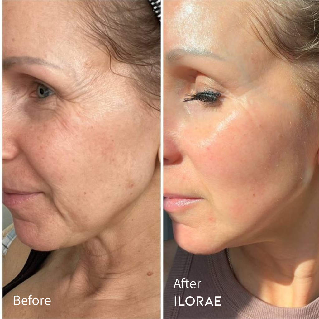 Needle-less Serum Before